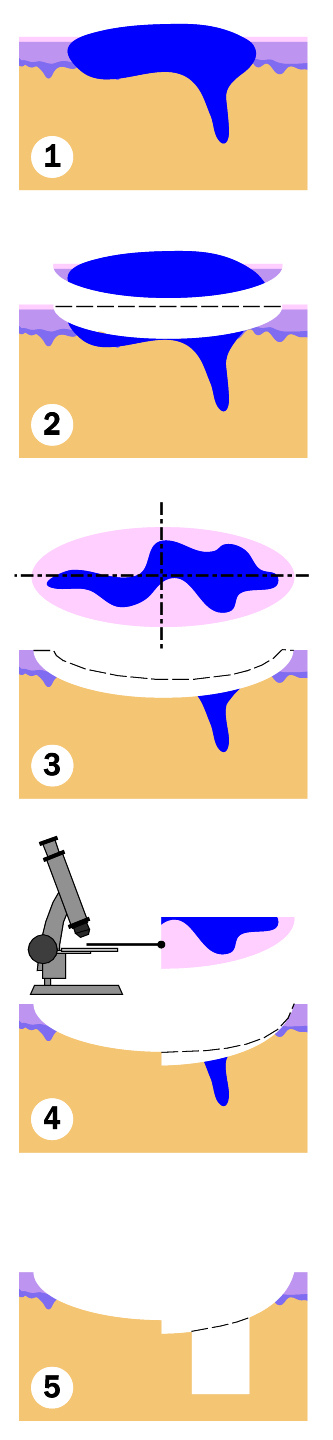 Mohs skin cancer surgery consultation